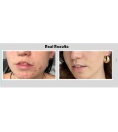 Cosrx Cosrx Blackhead Exfoliating Toner 4% BHA Niacinamide 2% - 100 ml